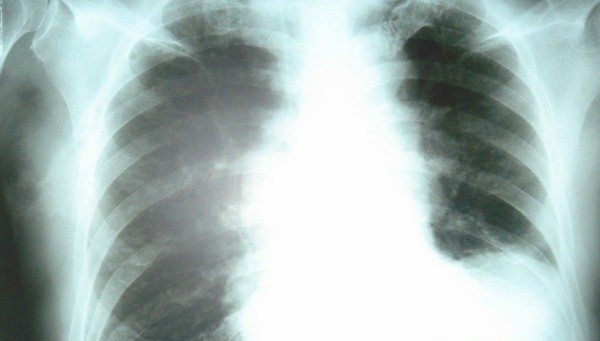 Xray of a lung infected with Pneumonia