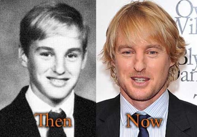 Owen Wilson's nose